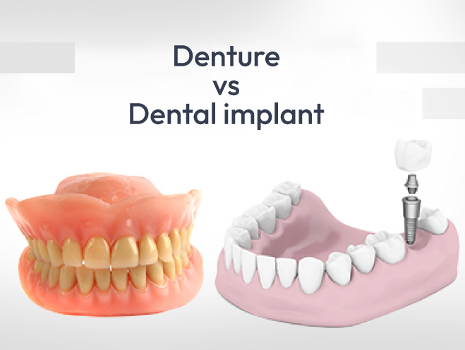 Comparison between dentures and dental implants with visual models.