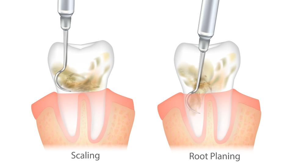 Illustration of dental scaling and root planing procedures on teeth.