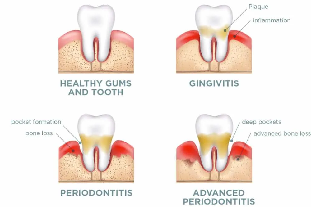 Stages of gum disease from healthy to advanced periodontitis.