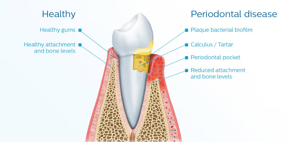 Illustration of periodontal disease showing plaque, calculus, and bone loss around a tooth.