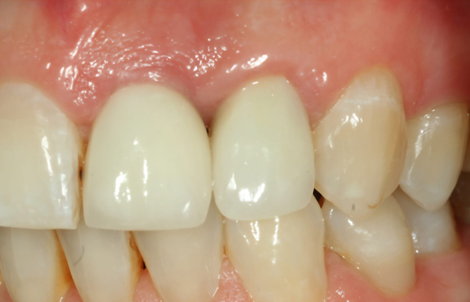 Close-up of dental crowns on natural teeth.