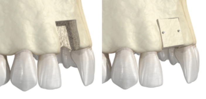 3D dental implant procedure showing tooth extraction and implant placement.
