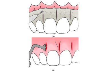 Illustration showing dental crown preparation and gum incision.