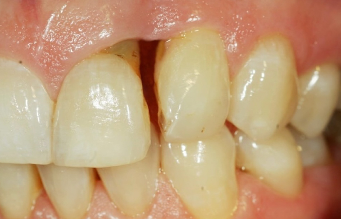 Close-up of teeth showing a gap between the front teeth.