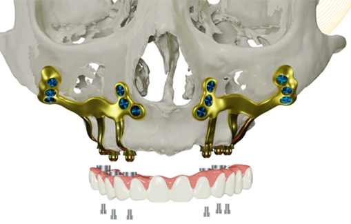 Digital dental implant planning with 3D jaw model and implant positions.