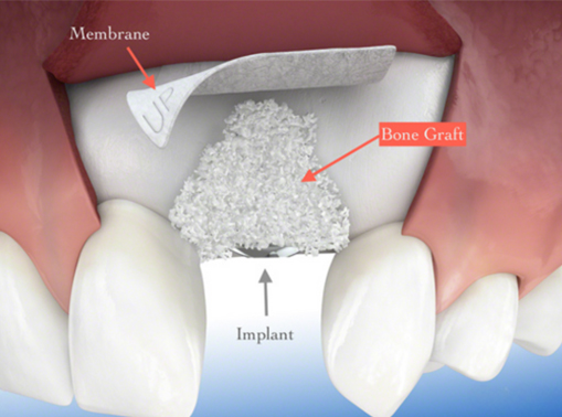 Dental implant procedure showing bone graft and membrane placement.