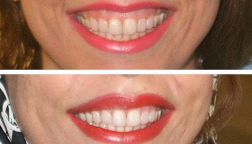 Before and after teeth whitening showing brighter smile.