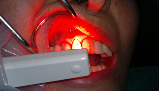Dental procedure using a curing light inside the mouth.