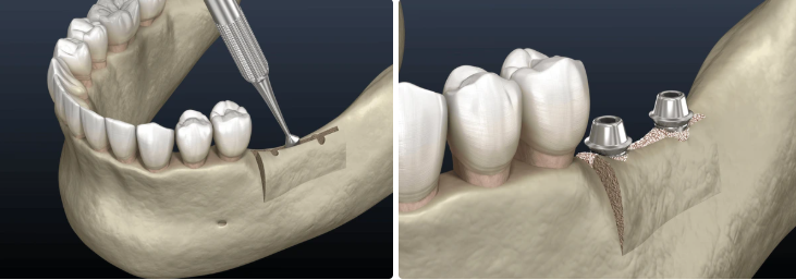 Dental implant procedure steps with a surgical guide and final placement.