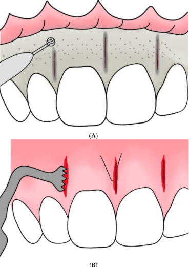 Illustration showing dental floss use and gum injury.