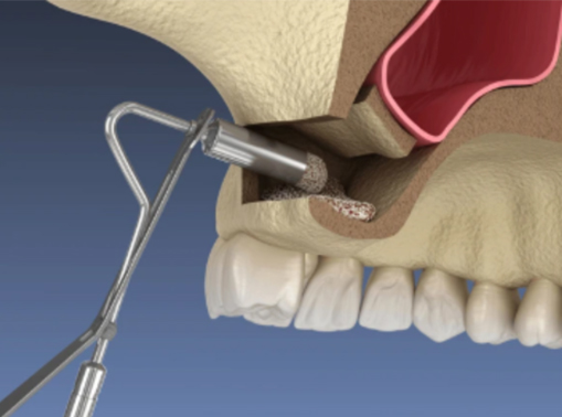 Dental implant drilling into jawbone near teeth.
