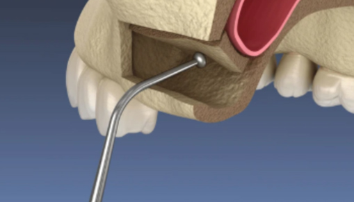 Dental tool cleaning or examining the root canal inside a tooth.