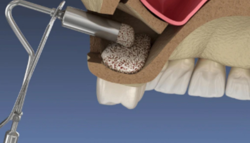 Dental bone graft procedure with bone graft material placement.