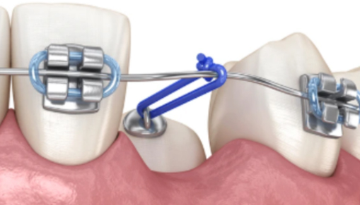 Dental floss threader aiding flossing around braces.