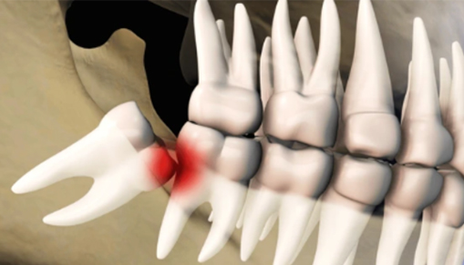 X-ray showing impacted wisdom tooth pressing against adjacent teeth.