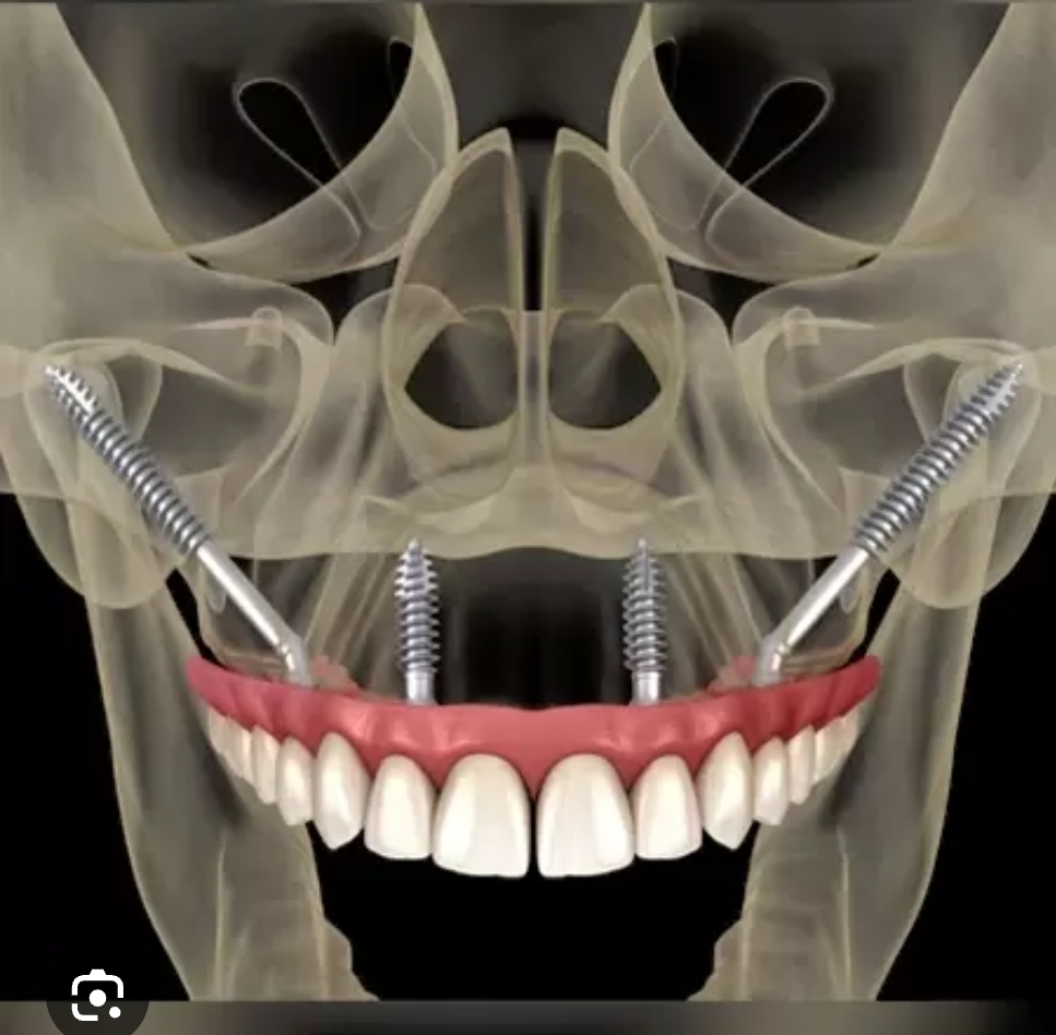 X-ray of jaw with dental implants and screws.