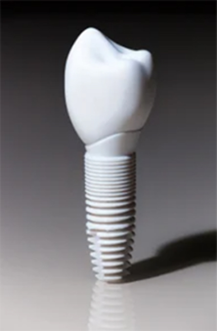 Close-up of a dental implant with a crown against a gray background.