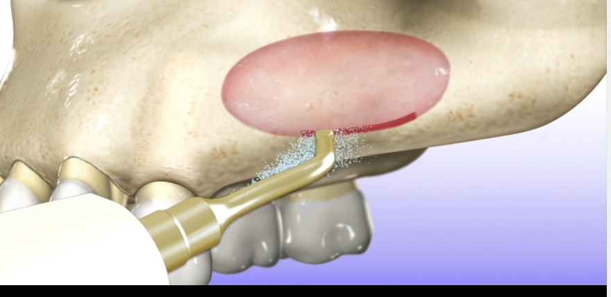Dental tool applying a pink dental material inside a tooth cavity.
