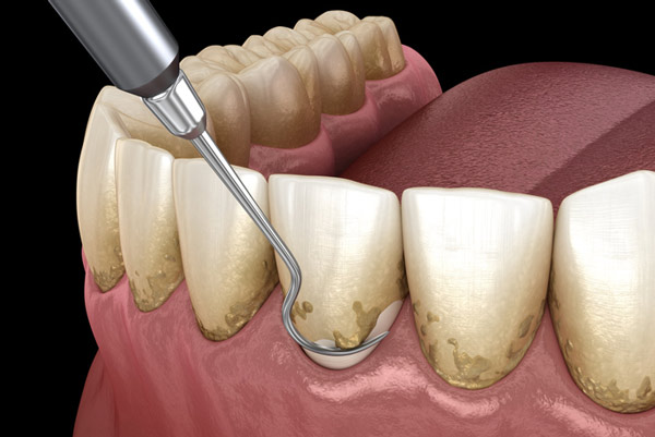 Dental cleaning tool removing tartar from teeth.