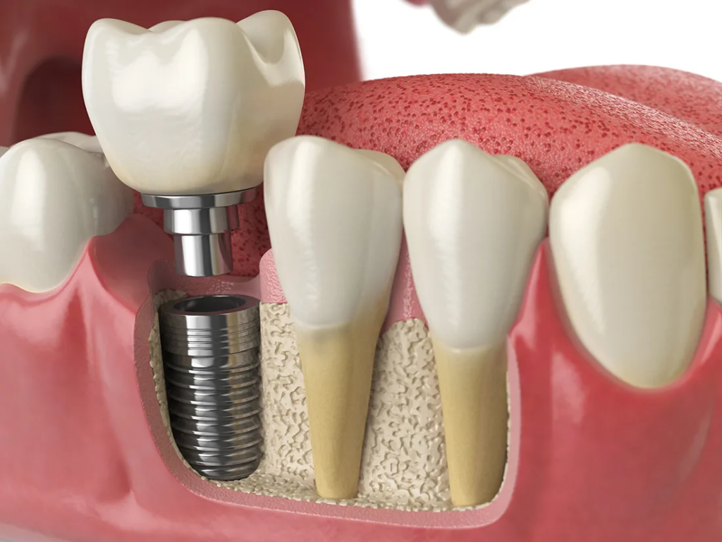 Dental implant inserted into jawbone beside natural teeth.