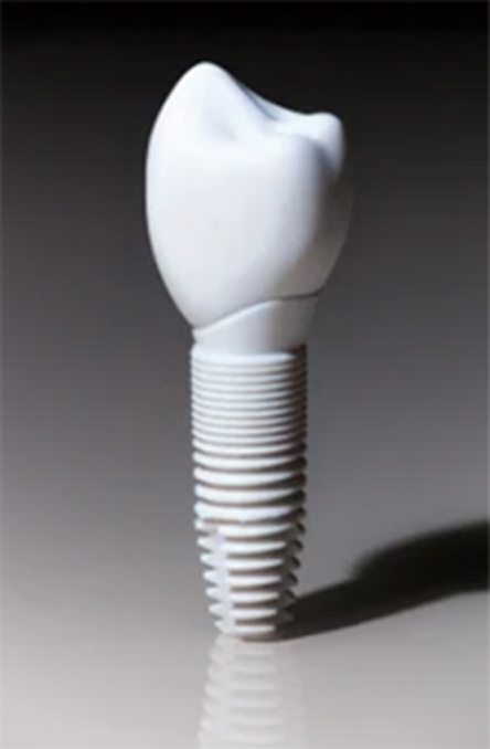A close-up of a dental implant with an artificial tooth attached.
