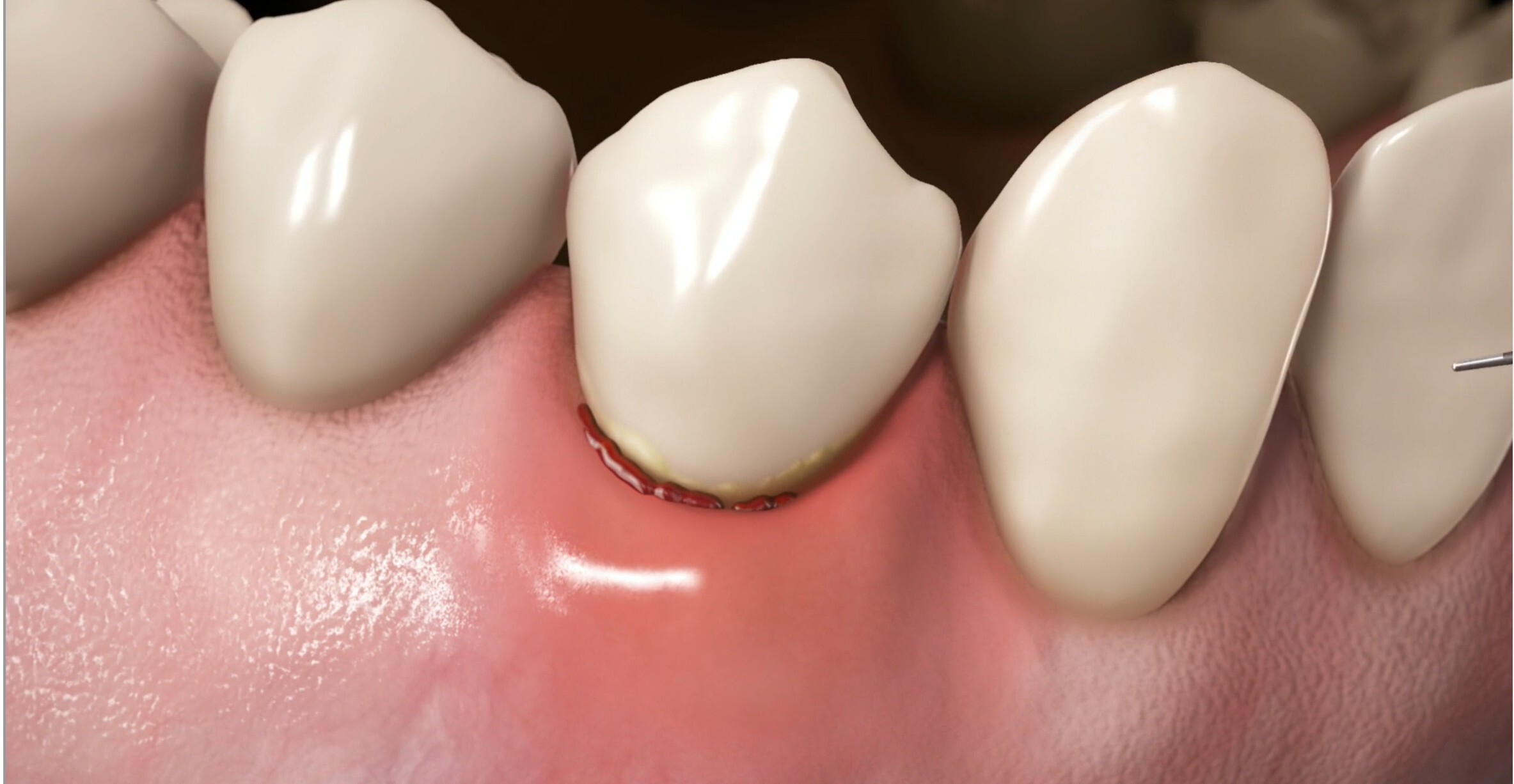 Close-up of a tooth with inflamed gum tissue and plaque buildup.