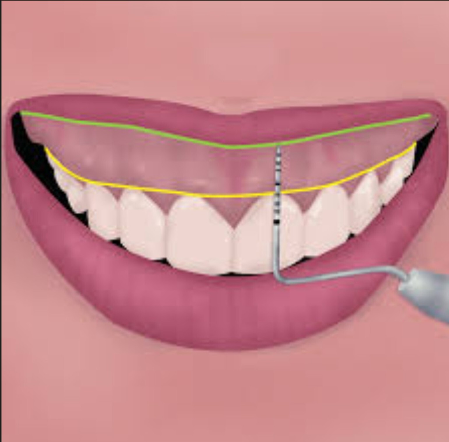 Digital dental scan showing teeth alignment and measurements.