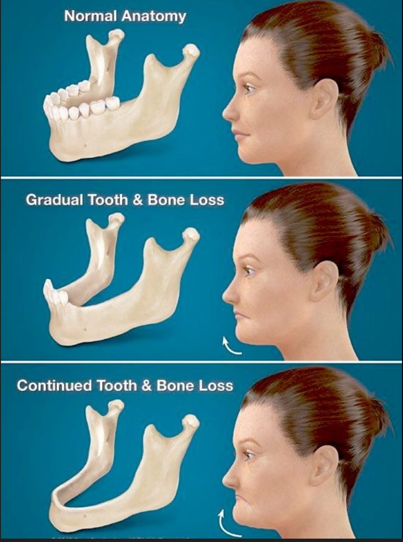 Illustration showing effects of gradual and continued tooth and bone loss on facial profile.