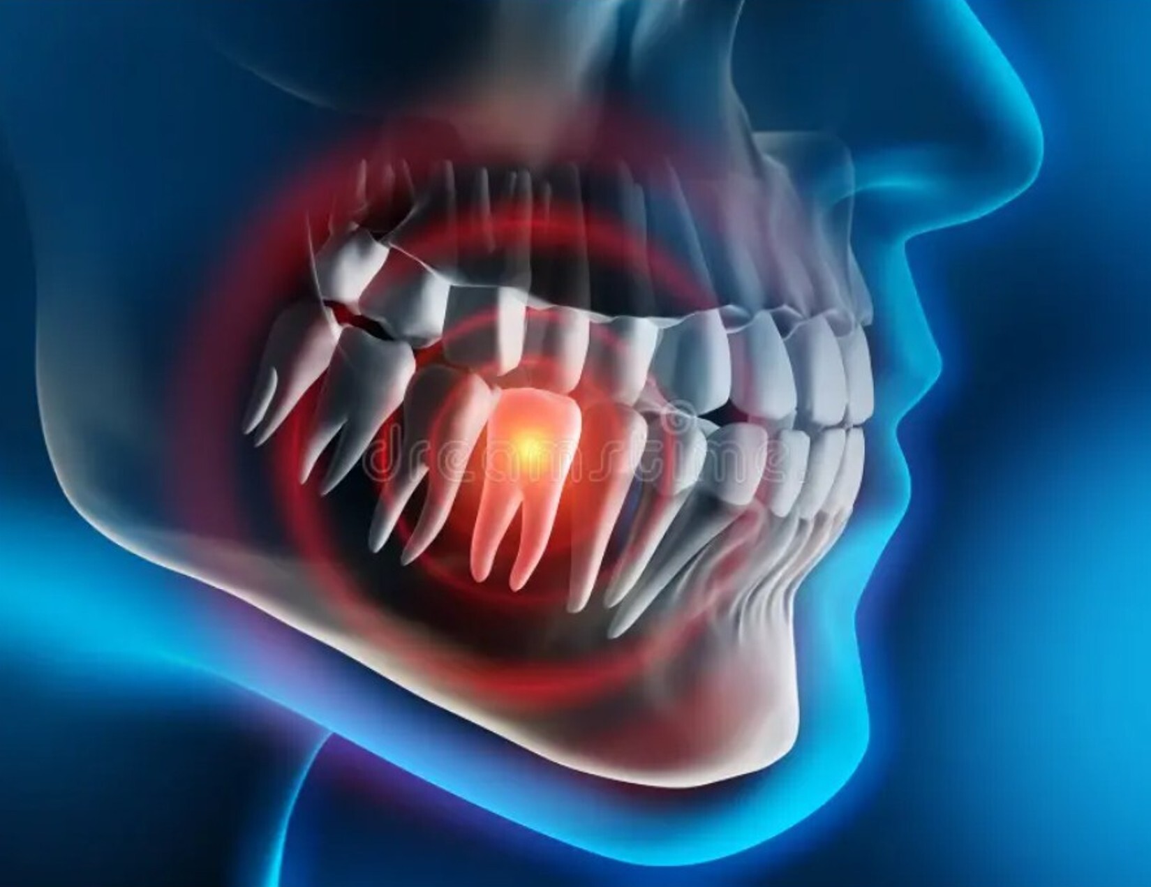 3D illustration of a toothache in the lower jaw.