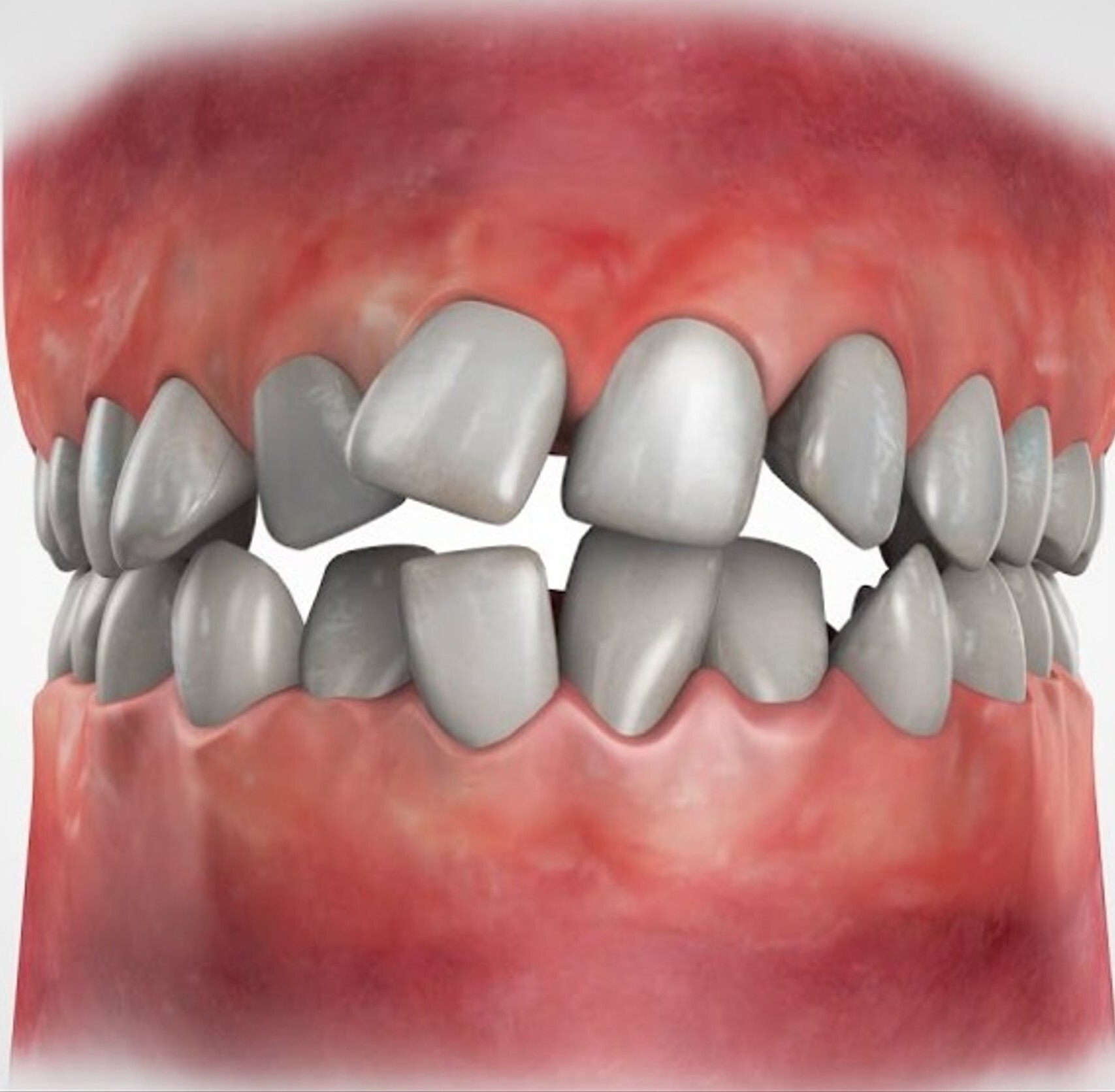 3D illustration of severely crowded and misaligned teeth.