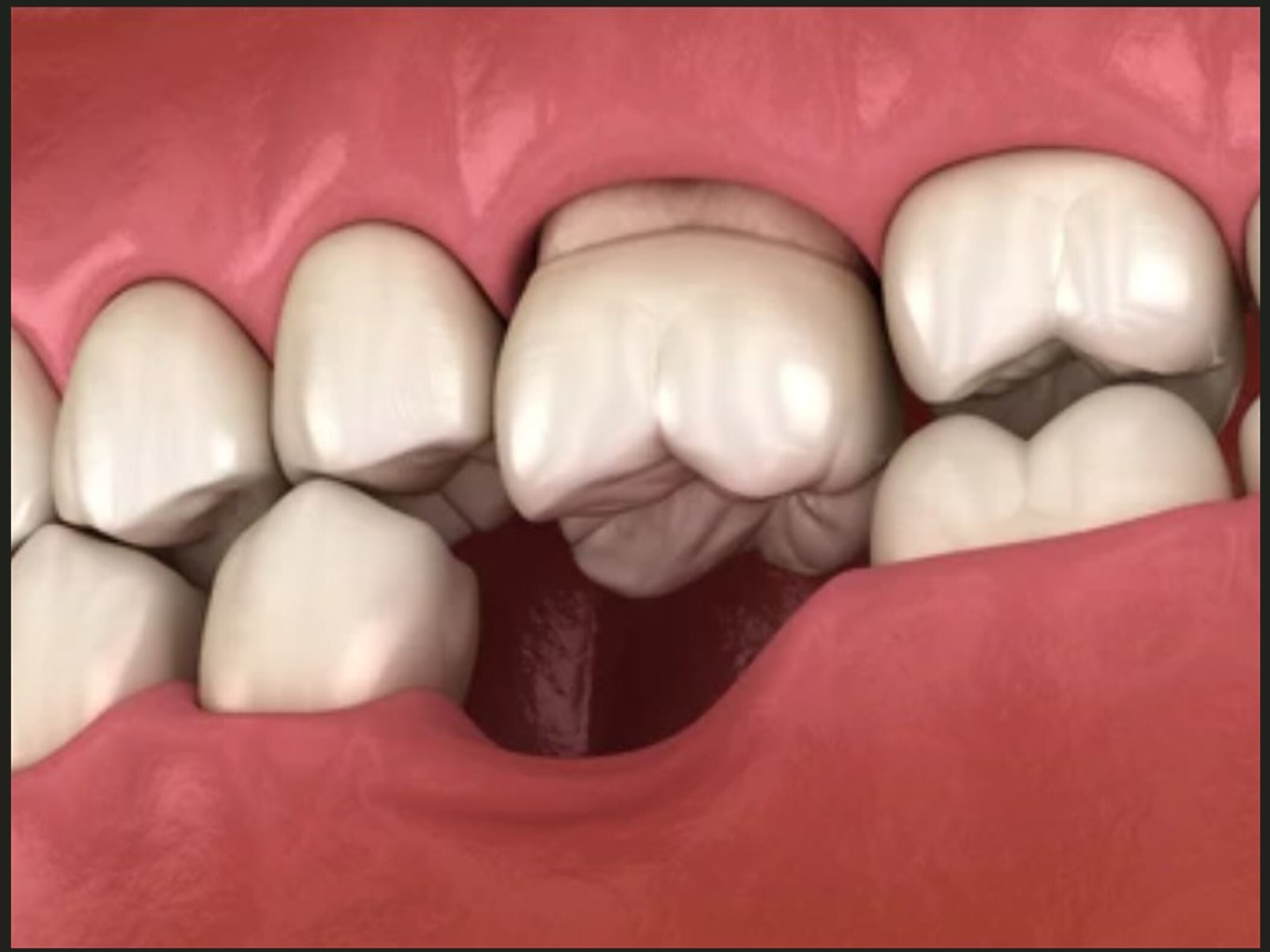3D illustration showing a missing molar tooth in gums.